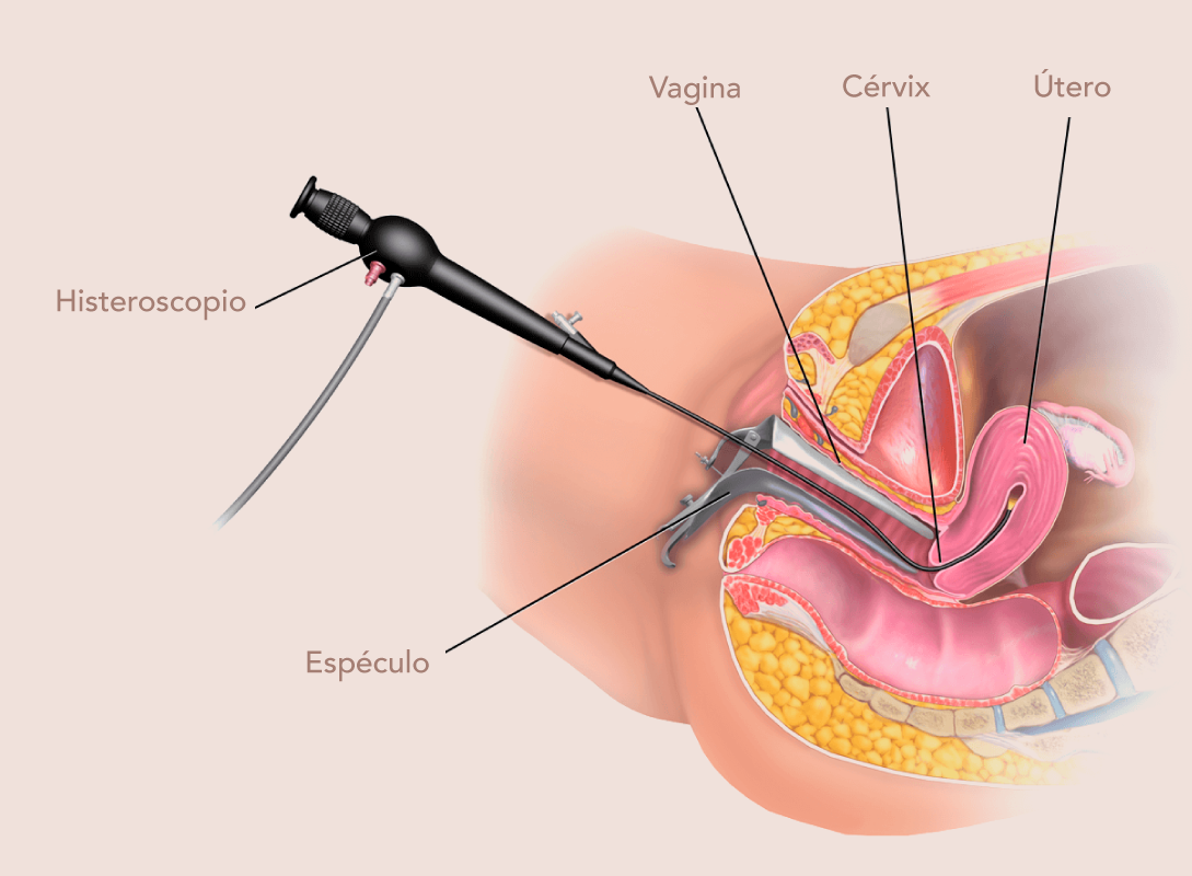 Histeroscopia diagnostica y operatoria Bogota